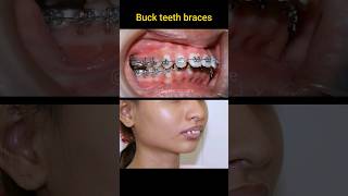 Buck teeth braces process braces niengrang orthodontist dental [upl. by Zilla]