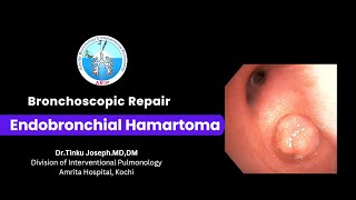 Endobronchial Hamartoma  Bronchoscopic Management [upl. by Aimekahs]