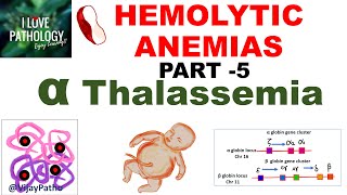 Hemolytic Anemias Part 5 Alpha Thalassemia Pathogenesis types Diagnosis amp Treatment [upl. by Ko]