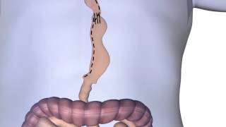 Esophagectomy Procedure Animation [upl. by Marieann]