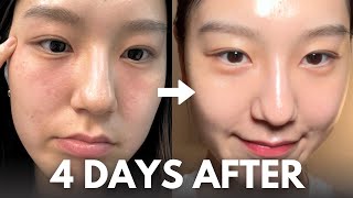 How I repair my skin barrier in 4 days at home with affordable skincare routine [upl. by Norud698]