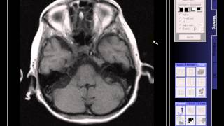 BRAIN MRI OLD INFARCTION [upl. by Girovard]