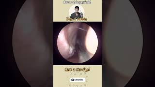 rhinorrhea sinusitis bersihkankuping satisfyingvideos pembersihan telinga video puas hati [upl. by Phio255]