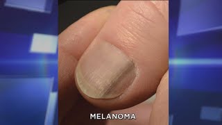 Subungual Melanoma What You Need to Know [upl. by Adnomal]