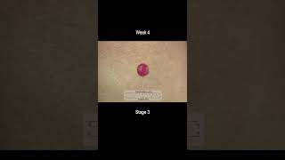 Merkel Cell Carcinoma Development Time Lapse  More Deadly Than Melanoma [upl. by Htedirem856]