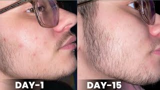 Day1 to day15 minoxidil beard growth results  minoxidil beard growth  derma roller for beard [upl. by Chance]