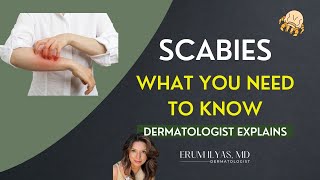 Scabies  How to manage [upl. by Eiramait]