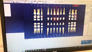 Reset your Dentrix Chart dentrix dental dentalsoftware dentalhygiene dentalhygienist [upl. by Lleder]