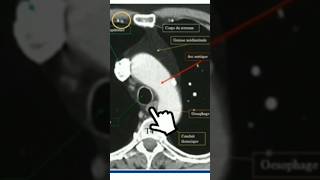 Scanner thoracique T4 anatomy medecine science anatomie scanner radiology radiologie [upl. by Aihsinyt]