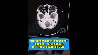 Subarachnoid hemorrhage  subdural hemorrhage  global brain ischemia  CT scan brain pediatrics [upl. by Baggs]