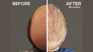 Severe Norwood 7 Hair Transplantation Results [upl. by Zebedee809]