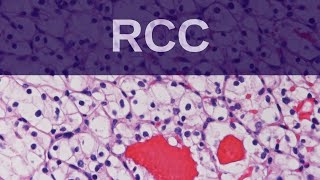 Renal Cell Carcinoma  Pathology mini tutorial [upl. by Nadaha]