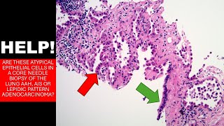 Atypical cells suspicious for adenocarcinoma AAH AIS [upl. by Odnama]