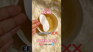 Natural🍃Acne💯toner💦pads🍯 Home🏡remedies🎀 treatment shorts natural acne homeremedies treatment [upl. by Grenville65]