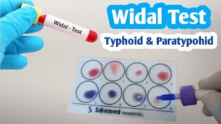 Widal Test  Salmonella Typhi amp Paratyphi Full Procedure  Typhoid fever [upl. by Bachman]