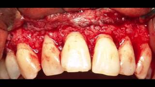 Surgical Crown Lengthening  Gummy Smile Treatment [upl. by Partridge]