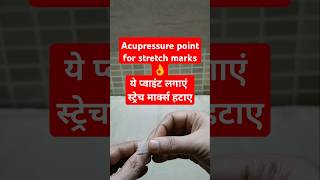 Points for stretch marks acupressure [upl. by Ainad]