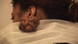 NonSurgical Ear Keloid Treatment [upl. by Joappa]