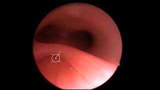 Laryngotracheal Cleft [upl. by Anauqed]