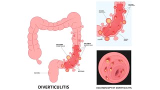 Divertikulitis [upl. by Hoopen]