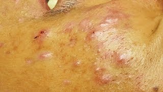 Enlever les points noirs les microkystes et un acné kystique a cystic acne [upl. by Treva]