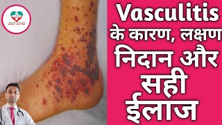 Vasculitis क्या होता है क्यू होता है इसका ईलाज कैसे होता है Vasculitis Hindi [upl. by Enaxor]