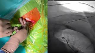 How to perform axillary vein puncture [upl. by Notsirt]