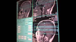 MRI brain diffusion amp flair [upl. by Linnell338]