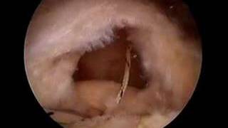 Arthroscopic Rotator Cuff Repair  Medium Supraspinatus Tear [upl. by Ainegul]