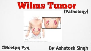 Wilms Tumor For 2nd year University Exams [upl. by Aracaj937]