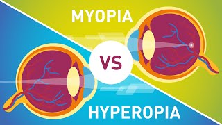 Difference between Myopia Near Sightedness amp Hyperopia FarSightedness [upl. by Almeria337]