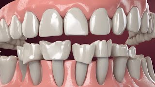 Discover the Benefits of Dental Bridges  How Can They Improve Your Smile [upl. by Michey]