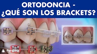 Ortodoncia – Brackets y otras partes del aparato dental © [upl. by Ennaehr880]