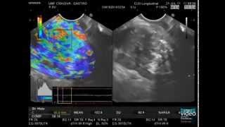 Pancreatic Cancer  Advanced EUS Imaging RealTime EUS Elastography [upl. by Marilyn]