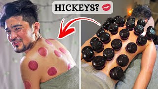 ASMR I Experienced HARDCORE Cupping Therapy That Gave Me Intense Hickeys 😉 [upl. by Langan]