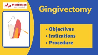 Gingivectomy l treatment of gingival overgrowth and gummy smile l Mediklaas [upl. by Colp]