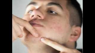 Get Rid Of Acne Scars  Best Acne Scar Treatment Remedies [upl. by Catie]