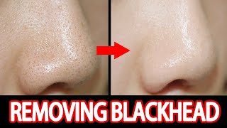 Removing Blackhead with 1 Vaseline [upl. by Auhso]