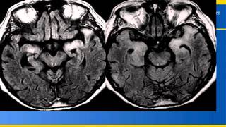 eRadiology Learning  Neuroradiology Pearls and Pitfalls 3 of 4 [upl. by Enitsahc685]