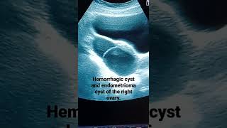 Ovarian Hemorrhagic cyst and endometrioma cyst in patient with irregular bleedingperiod [upl. by Bogie789]