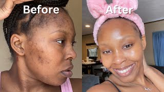 How I Cleared My Acne  Dark Spots  Hyperpigmentation for good in 1 month NO ACCUTANE VIDEO PROOF [upl. by Ahsinan820]