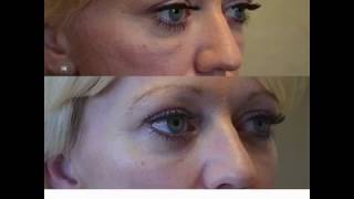 Dissolving Under Eye Fillers  Kami Parsa MD in Beverly Hills CA [upl. by Schiffman286]