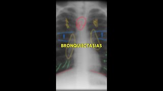 Bronquiectasias no RX [upl. by Schifra310]