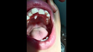 supernumerary teeth treatment  extra teeth treatment subscribe like 🦷 [upl. by Base]