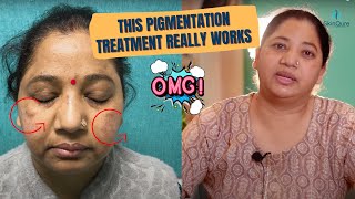 Melasma Treatment  Pigmentation Treatment in Delhi by Dr Jangid  Patient Testimonial  SkinQure [upl. by Laura]