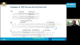 PREVENTION OF SUDDEN CARDIAC DEATH ROLE OF ICD Dr K K Narayanan Namboodiri CHRS [upl. by Robma32]