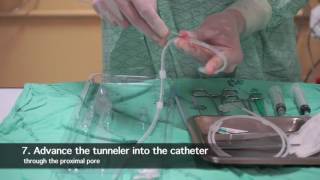 TK Catheter insertion for peritoneal dialysis by nephrologist [upl. by Yong548]