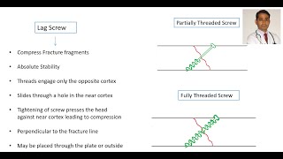 Lag Screw Principle [upl. by Sheepshanks]