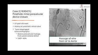 4 challenging cases in a single working day in Cathlab No 8 TAVI Paravalvular ASD and SVC [upl. by Airoled]