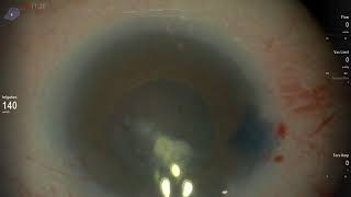 Phaco In Micro Cornea [upl. by Stargell923]